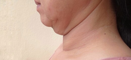 Under the chin of a woman there are wrinkles.