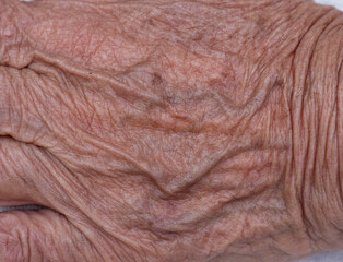 Skin changes in old age