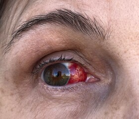 Hémorragie intra oculaire, détail  - 464825078