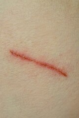 Fototapeta premium one red long scratch cut on gray skin of hand