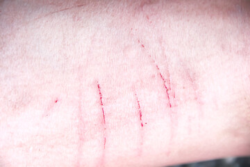 Wound scratch  and blood on asian woman leg skin Accident from sharp thorn of rose prickly branches