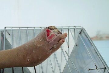 Diabetic  foot ulcer, infection  wound  at foot in the imergency room .