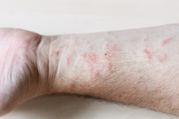 sample of Allergic contact dermatitis - rash on inner side of forearm close up