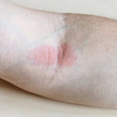 sample of Allergic contact dermatitis - redness on iinner bend of the elbow close up - obrazy, fototapety, plakaty