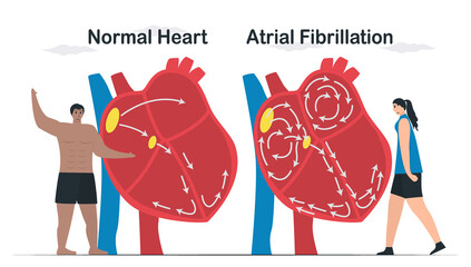 Data comparison of Normal heart and Atrial fibrillation. AF is common type of irregular heartbeat. Electrical signals in atrium cause atrium to beat quickly and erratically. cardiology vector. - obrazy, fototapety, plakaty