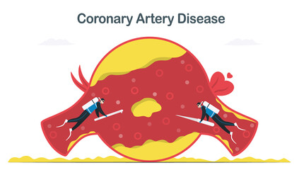 Coronary artery disease treatment that caused by atherosclerosis. More cholesterol and fatty deposits in blood vessel. Cardiology vector illustration isolated on white background.