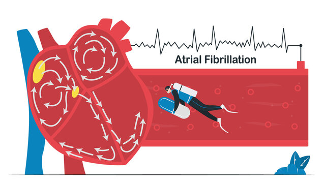 Doctor treats a heart disease that is atrial fibrillation. AF is common type of irregular heartbeat. Electrical signals in atrium cause atrium to beat quickly and erratically. Cardiology vector.