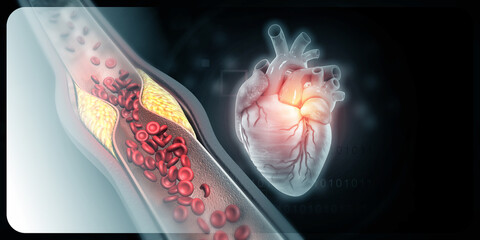 Cholesterol plaque in artery with Human heart anatomy. 3d illustration - obrazy, fototapety, plakaty