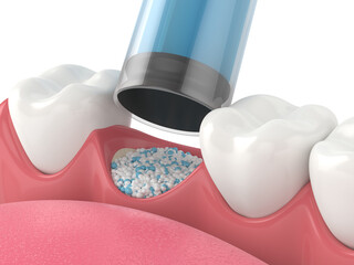 3D render of dental bone grafting with dental bone biomaterial application - obrazy, fototapety, plakaty