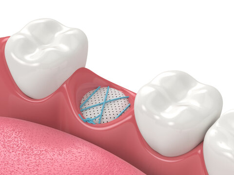 3D render of dental bone grafting with membrane and sutures