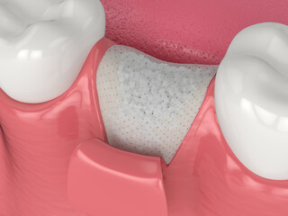 3D render of dental bone grafting with bone biomaterial and membrane - obrazy, fototapety, plakaty