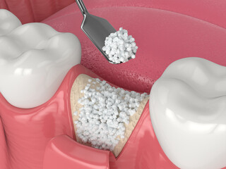3D render of dental bone grafting with bone biomaterial application - obrazy, fototapety, plakaty