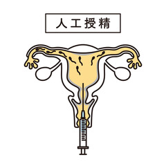シンプル　イラスト　人工授精