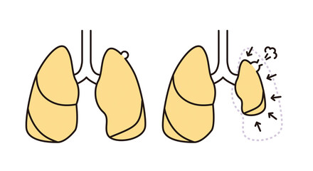 シンプル　イラスト　肺気胸