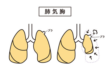 シンプル　イラスト　肺気胸