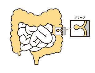 シンプル　イラスト　大腸にできたポリープ