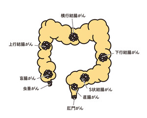 シンプル　イラスト　大腸のがん発生部位