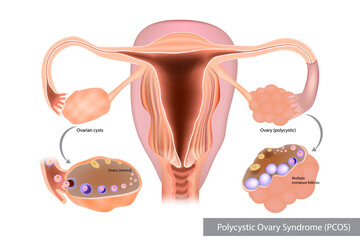 Polycystic Ovary Syndrome PCOS. Multiple immature follicles or Ovarian cysts. Reproductiv. - obrazy, fototapety, plakaty