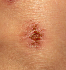 Fototapeta premium A wound on the body. Skin regeneration. Limb injury.