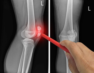 Close up X-ray knee AP-Lateral showing fracture patella or knee cap. pain in a man, Doctor holding a red pen point , symptoms medical healthcare concept. - obrazy, fototapety, plakaty