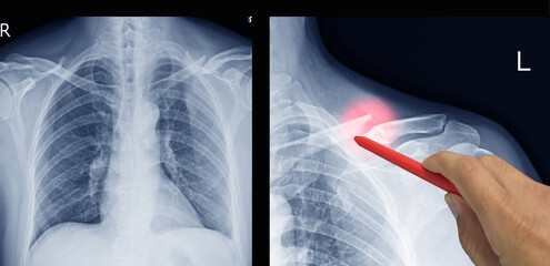 Close up X-ray Shoulder and clavicle fracture pain in a man, Doctor holding a red pen point , symptoms medical healthcare concept.