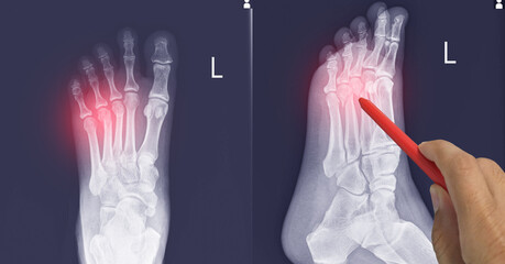 Close up X-ray Foot  AP-Lateral showing fracture 3th,4th metatarsal bone, Doctor holding a red pen point , symptoms medical healthcare concept.