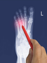 Close up X-ray Foot  AP-Lateral showing fracture 3th,4th metatarsal bone, Doctor holding a red pen...