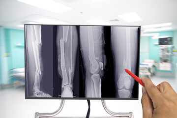 Close up X-ray whole leg bone showing fracture multiple fractures bone, Doctor holding a red pen...