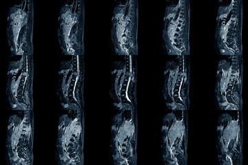 Lumbar spinal stenosis MRI scan Sagittal view finding moderate posterior inferior tumor protrusion cause bilateral root compression. Chronic low back pain disease - obrazy, fototapety, plakaty