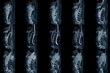 Fotobehang Lumbar spinal stenosis MRI scan Sagittal view finding moderate posterior inferior tumor protrusion cause bilateral root compression. Chronic low back pain disease © Richman Photo
