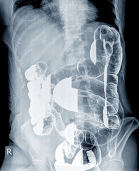 Radiological examination to look for colon abnormalities By enema the barium powder and air into...