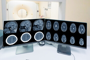 Close up CT-scan control room and showing brain image meningioma in brain CT scan room background, Medical healthcare, and technology concept.