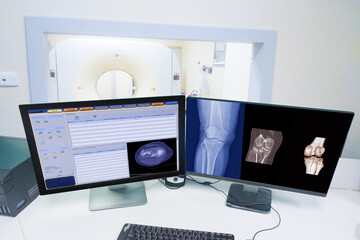 Close up Computer monitor Scan control room and computer showing knee scan fracture, Medical technology concept