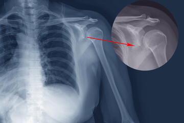 X-ray shoulder Fracture posterior half of glenoid with posterior dislocation of the bone fragment.