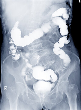 Radiological examination to look for colon abnormalities By enema the barium powder and air into the anus. Then x-ray was done. Medical image concept.