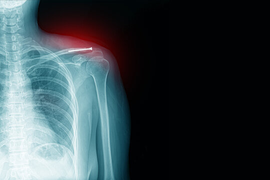 x-ray image of shoulder pain with clavicle fracture with post-op and screw medical healthcare concept.copy space