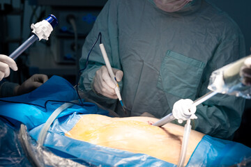 Selective focus on the hands of a surgeon with an electric coagulator over the patient's body during surgery. Close-up of a doctor's hand in sterile gloves operate with a surgical instrument.