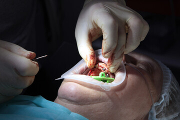 Operation to install multiple implants in dental clinic. Old man. Close-up. Unrecognizable person.