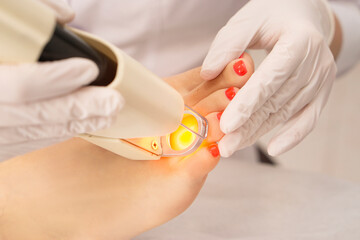 close-up of the doctor's hands doing laser epilation Adeksatdritovy ray burns hair epilation on the...