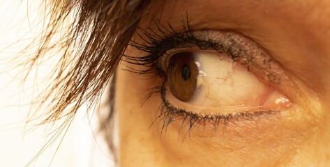 A nice brown chestnut eye of a Mediterranean Latin woman, showing a  conjunctival stromal...