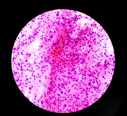 Malignant effusion (cancer cells): Pleural fluid cytology of lung (pulmonary) papillary...