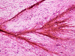 Fine needle aspirate cytology of metastatic melanoma, with large malignant cells. In the center of...