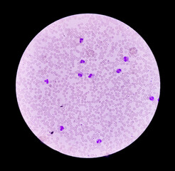 Blood smear Microscopic show increase number of Eosinophils a type of white blood cells, WBC...