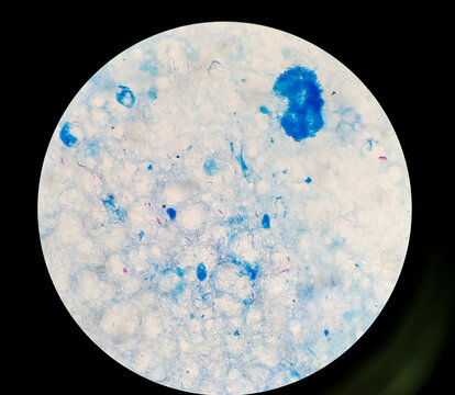 Bacteria Mycobacterium tuberculosis, the causative agent of tuberculosis, can be used for M. leprae, M. avium complex and other mycobacteria, Sputum Ziehl-Neelsen (ZN) stained AFB micrograph