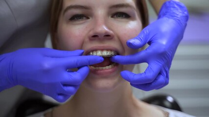 Close-up of orthodontist trying on aligners for patient mouth during consultation in clinic spbas. Young woman doctor holds transparent models and inserts it into oral cavity, female looks with smile