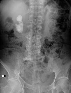 x ray image of renal stone,kidney stone,nephrolithiasis