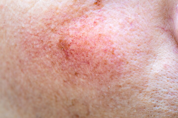 Red face, skin discoloration, broken blood vessels, health problems