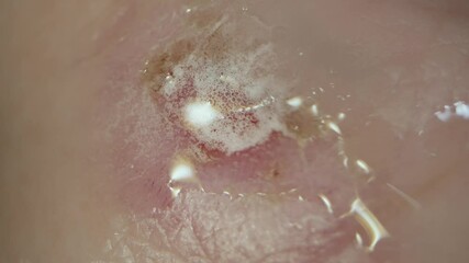 This ultra close up, macro POV video shows hydrogen peroxide being poured on a bloody open wound and bubbling up.