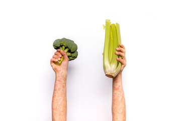 Broccoli, celery and psoriasis hands