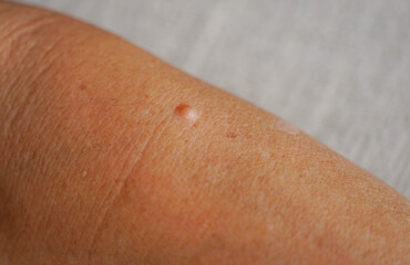 a mole on senile man skin, selective focus